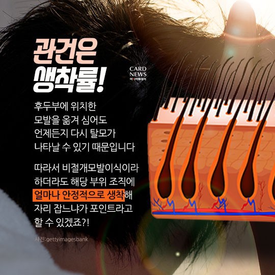 [카드뉴스] “소중한 머리카락 왜 자꾸 빠질까?”... 탈모 원인 및 치료법? 