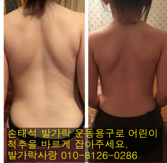 어린이 척추측만증
